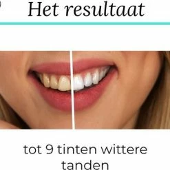 SmileKit Teeth Whitening Strips - Tanden Bleken - Tandenbleekset - Tandenbleek Strips - 100% Natuurlijk/Vegan - 28x Tandenbleek Strips - (0%) Peroxide - Activated Houtskool & Kokosolie - Beauty - Frisse Adem -Oral B SHOP 550x422 2