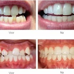 Edoir Rechte Tanden Beugel - Retainer Voor Rechte Tanden - Rechte Tanden Bitje -Oral B SHOP 550x425 1