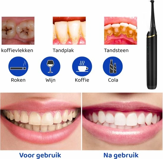 ExCorn Elektrische Tandsteen Verwijderaar - Elektrisch Tandplak Verwijderen - Inclusief Tandartssetje - Tanden Polijsten 4 ExCorn Elektrische Tandsteen Verwijderaar - Elektrisch Tandplak Verwijderen - Inclusief Tandartssetje - Tanden Polijsten - Afbeelding 4