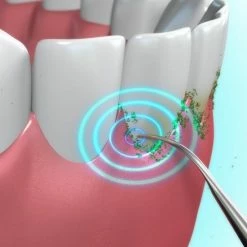 Toppers Van TV - Sonic Tandsteenverwijderaar - Tandplakverwijderaar -Oral B SHOP 550x550 1053