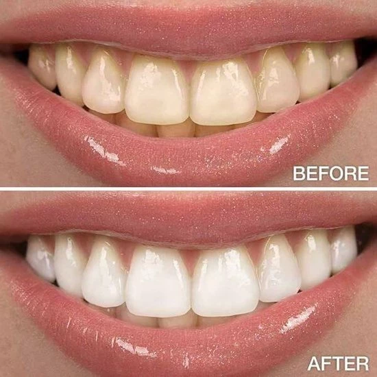 Perfect Wit - Whitening Pen - Tandenblekers - 100% Natuurlijke Ingredi?nten - Peroxidevrij - Veilig Bleken - Witte Tanden - Tandbleekset - Tanden Bleken - Whitening - Teeth Whitening - Frisse Adem 8 Perfect Wit - Whitening Pen - Tandenblekers - 100% Natuurlijke Ingredi?nten - Peroxidevrij - Veilig Bleken - Witte Tanden - Tandbleekset - Tanden Bleken - Whitening - Teeth Whitening - Frisse Adem - Afbeelding 8