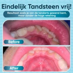 ProTrue Whitee Elektrische Tandsteen Verwijderaar - Tanden Polijsten - Tandarts Tandsteenverwijderaars - Elektrisch Tandplak Verwijderen -Oral B SHOP 550x550 914