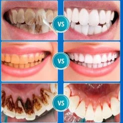 B-care Tanden Bleker ? Wittere Tanden ? Teeth Whitening Strips ? Professioneel Resultaat - Tandsteen Verwijderaar - Zonder Peroxide - Tandenbleekset - Tanden Bleken - Black Friday ? Sinterklaas ? Schoencadeautjes Sinterklaas -Oral B SHOP 550x558