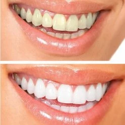 Tandenbleekset - Inclusief Teeth Whitening Strips + Wipes + 3 Gelspuiten - Zonder Peroxide 100% Natuurlijk - Dierproefvrij - Wittere Tanden - 3D LED - Teeth Whitening - Premium Edition Statch -Oral B SHOP 550x580 4